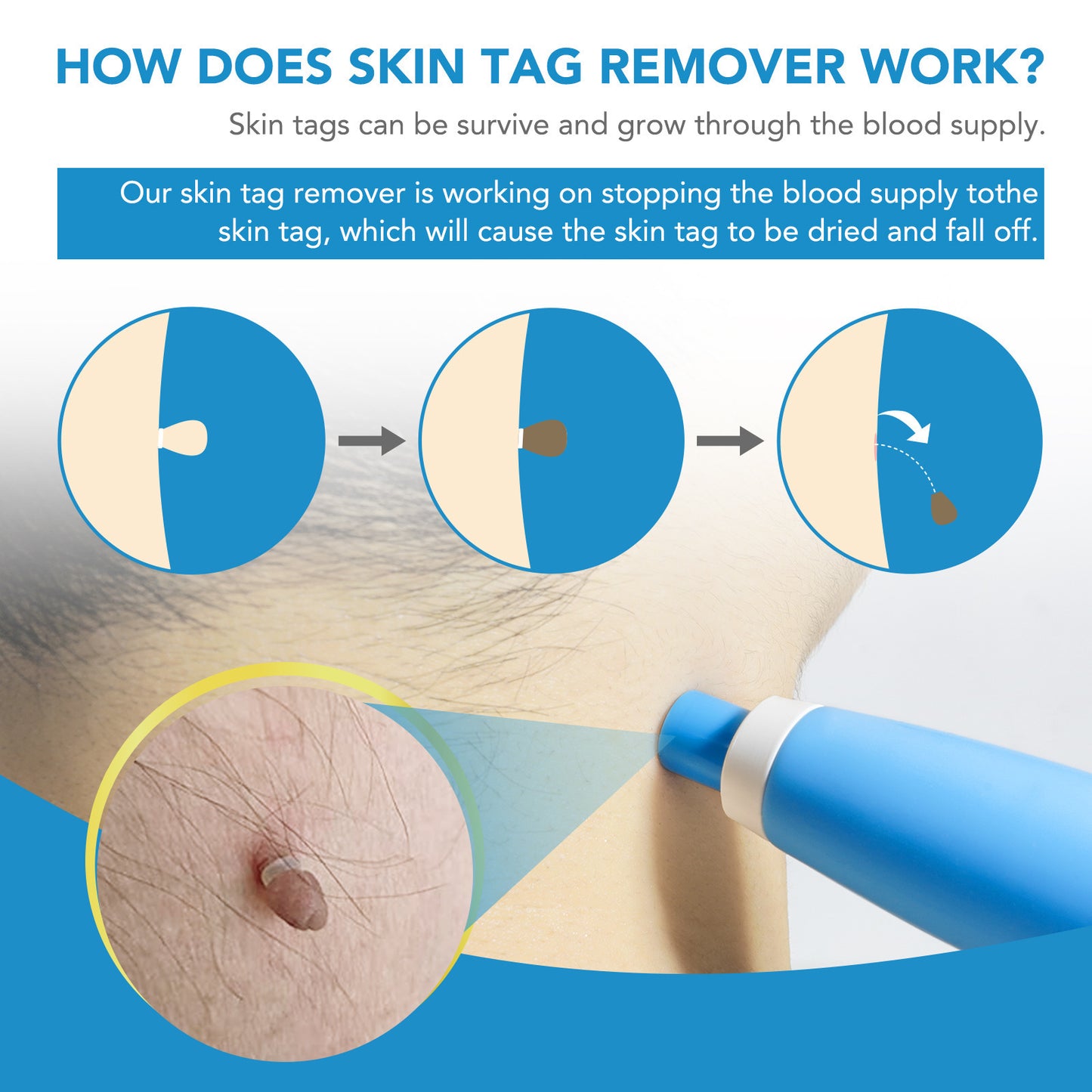 🔥Hot Sale🔥 Skin Tag Auto Remover 2 in 1 Kit