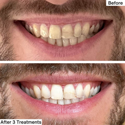 🦷Dentist-Approved Teeth Whitening Powder